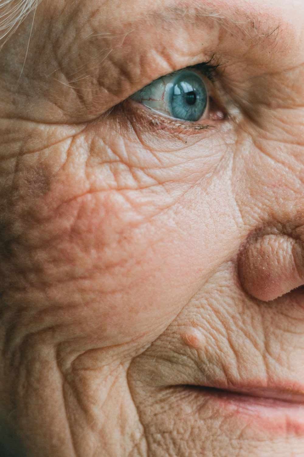 Skin Care After Laser Resurfacing of the Face