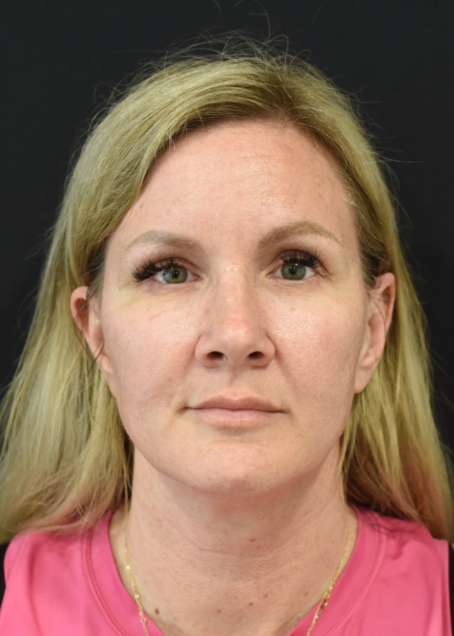 Extended Deep Plane Facelift Patient 44 Set 1 Before
