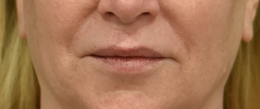 Lip Lift Patient 7 Set 1 Before