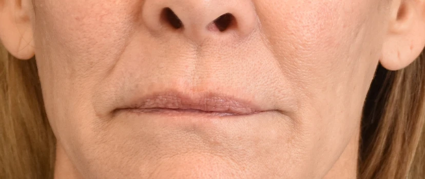Lip Lift Patient 14 Set 1 Before
